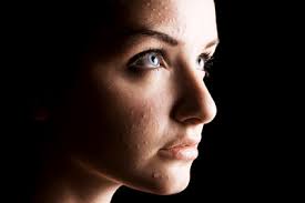 Resultado de imagen de pieles grasacon acne