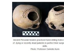 ancient surgery tools and trepanned skull archaeology resmi