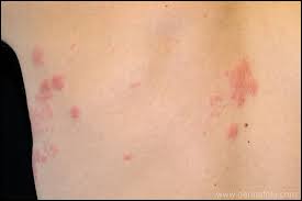 Image result for "Herpes Zoster"