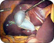 Ablation de vesicule biliaire