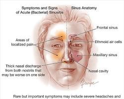 Image of Bacterial rhinosinusitis symptoms