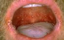 Han Foot, and Mouth Disease (Coxsackie Virus) - Children s