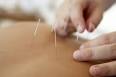 Maigrir par acupuncture - Ooreka