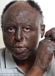 Bravery behind the mask: Kwasi Afari Minta, who was the most badly burned of the King&#39;s Cross survivors, says he feels lucky - article-0-161BE3F0000005DC-914_306x423