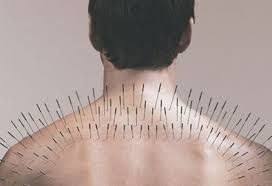 Image result for ‫طب سوزنی‬‎