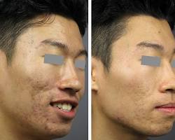 Image of Q switch laser acne scars