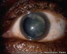 eye cataract cloudy lens photo wikipedia, AI generated