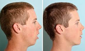 Image result for jaw surgery