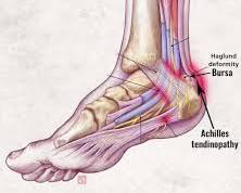 Image of heel bursitis
