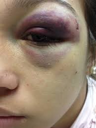 Resultado de imagem para foto de um olho roxo de soco