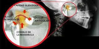 Resultado de imagen para artritis reumatoide en atm