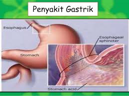 Image result for gastrik