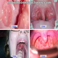 Image result for tonsilith