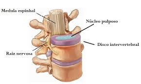 Resultado de imagem para inicio da degeneração do disco intervertebral