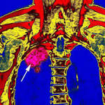  A New Lung Cancer Drug Is Shaking Up Treatment: How Does It Work?