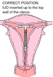 Image result for IUD image