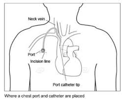 Image result for show image of port catheter in chest