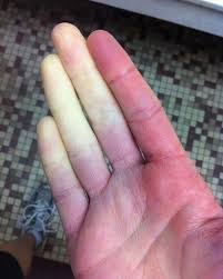 This is a patient with Raynaud phenomenon!! - MEDizzy