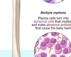 Image of Multiple Myeloma cancer cells