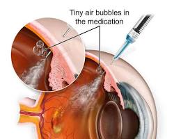 Image of AntiVEGF eye injection