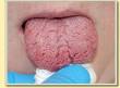 Dry mouth syndrome