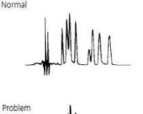 Image of Loss of resolution in chromatography