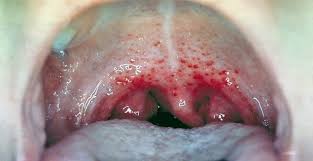 Hasil gambar untuk sakit tenggorokan