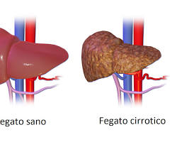 Immagine di Cirrosi epatica