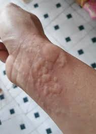 Nổi mề đay do gan n&oacute;ng: 5 dấu hiệu cảnh b&aacute;o b&agrave; con chớ coi ...