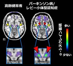 Team in Japan Making Progress in Understanding Parkinson's - 1