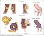 Traiter d urgence les occlusions intestinales - Allodocteurs