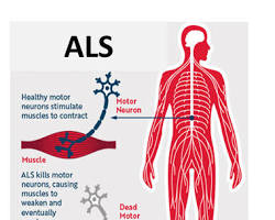 صورة مرض التصلب الجانبي الضمورى (ALS)