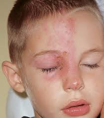 Image result for "Herpes Zoster"