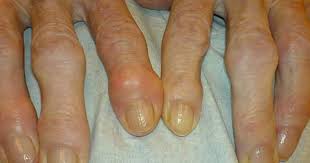 نتیجه تصویری برای نقرس