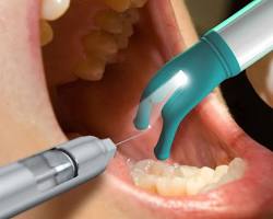 Image of Ống tiêm gây tê trong nha khoa thực tế