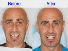 Mr.Michael Nicholas / Sydney – Australia Sea Smile Dental clinic, Phuket. Treatment : Porcelain Veneer …It is great to regain a nice confident smile and get ... - Mr.Michael%2520Nicholas