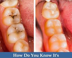 What are the types of Dental Treatment?