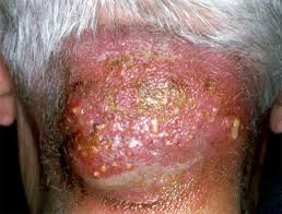 Image result for carbuncle