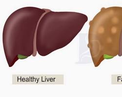 Image of liver with and without fatty deposits