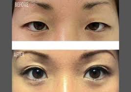 Image result for japanese women taping eyelids