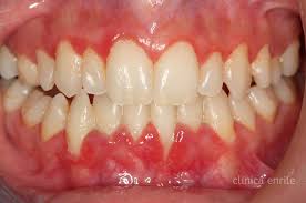 Resultado de imagen para gingivitis