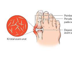 Gambar Penyakit asam urat