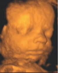 Figure 11, a 3-D ultrasound image of a fetal face at 27 weeks gestation. Image courtesy of Stefano Ciatti, M.D. - 2003_12_30_14_25_33_706