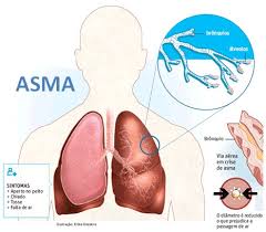 Informasi tentang asma untuk remaja 