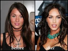 Resultado de imagem para before after surgery