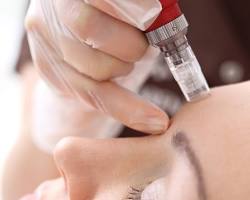 Image of Microneedling treatment