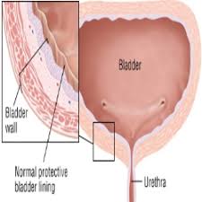 http://ginekologi.org/cystitis