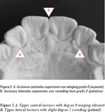 Résultat de recherche d'images pour "shovel shaped incisors"