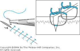 Image result for simple continuous suture pattern