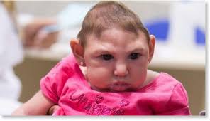 Image result for images of zika babies